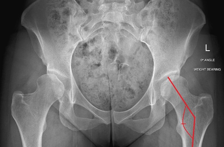 Hip Dysplasia: What’s With All Those Angles?