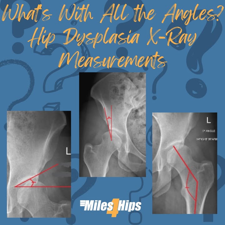 Miles4Hips